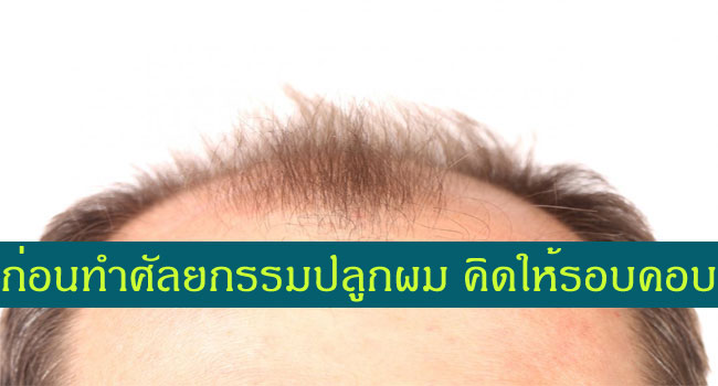 ปลูกผมด้วยวิธีศัลยกรรมปลูกผมถาวร ก่อนทำควรคิดให้ดี ดูข้อดีข้อเสียให้รอบคอบ
