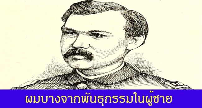 ผมร่วงผมบางในผู้ชายสาเหตุมาจากกรรมพันธุ์